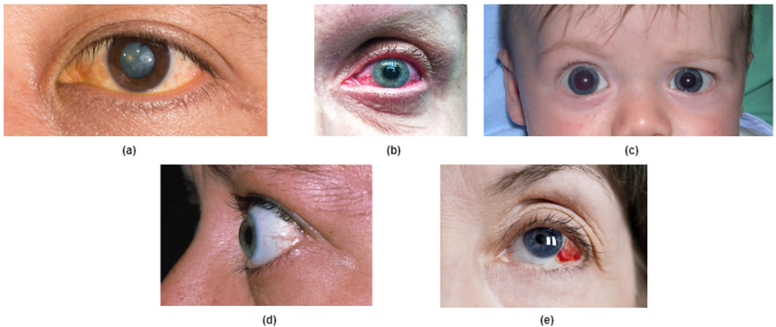 SmartVision – Image Classifier for Eye Diseases